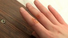 Лечим порез. Доброе утро. Фрагмент выпуска от 11.03.2016